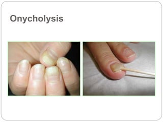 Onycholysis
 