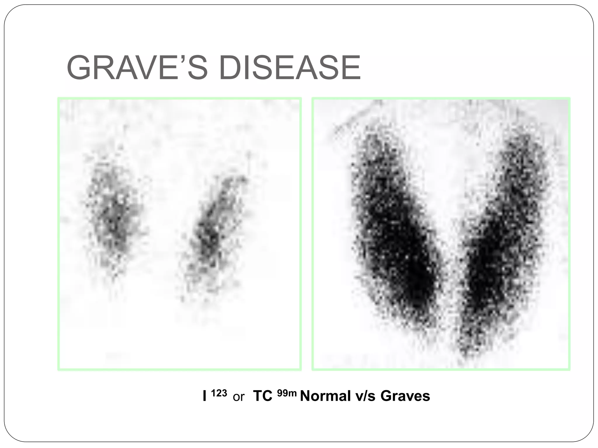 GRAVE’S DISEASE
I 123 or TC 99m Normal v/s Graves
 