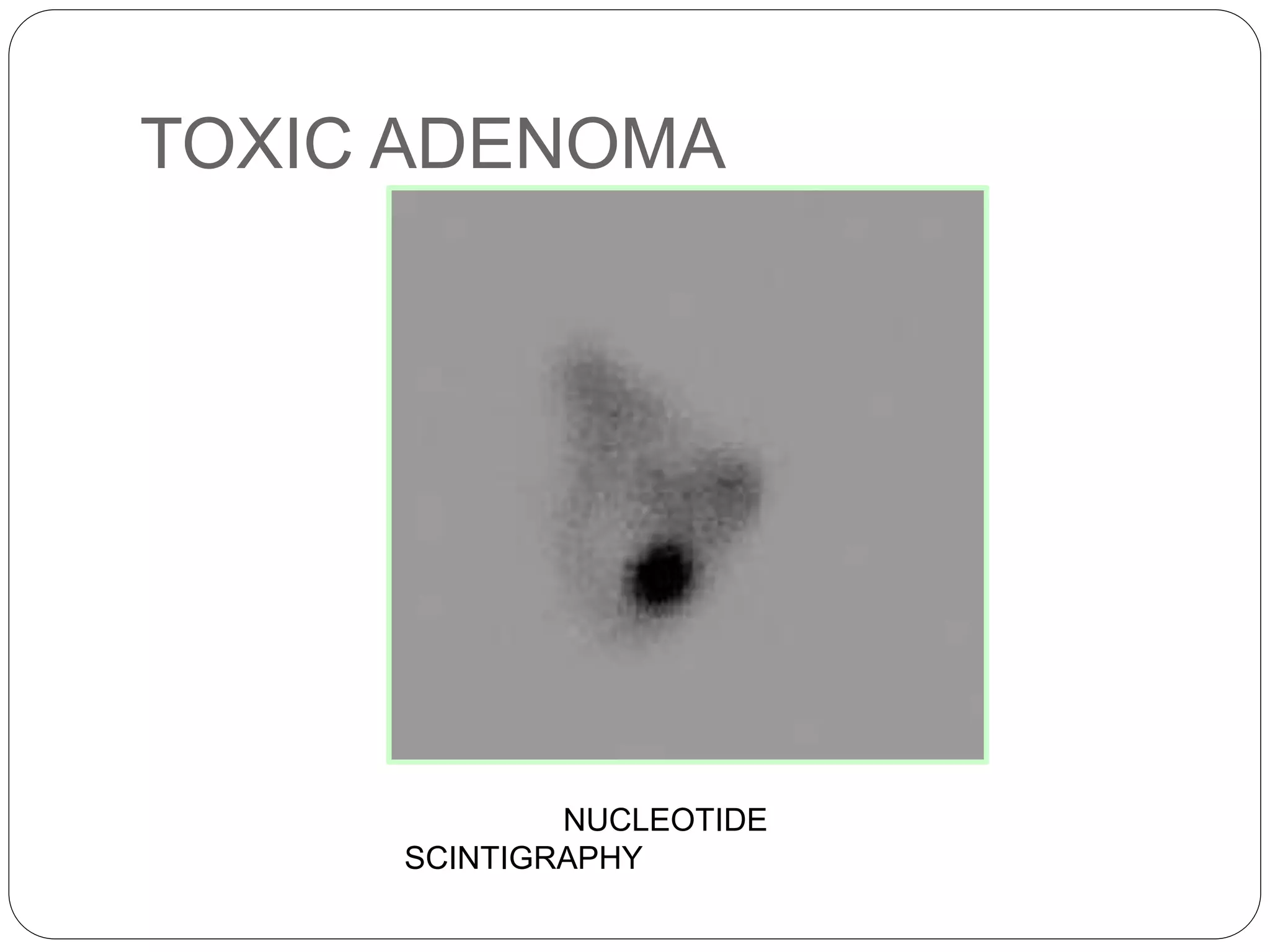 TOXIC ADENOMA
NUCLEOTIDE
SCINTIGRAPHY
 