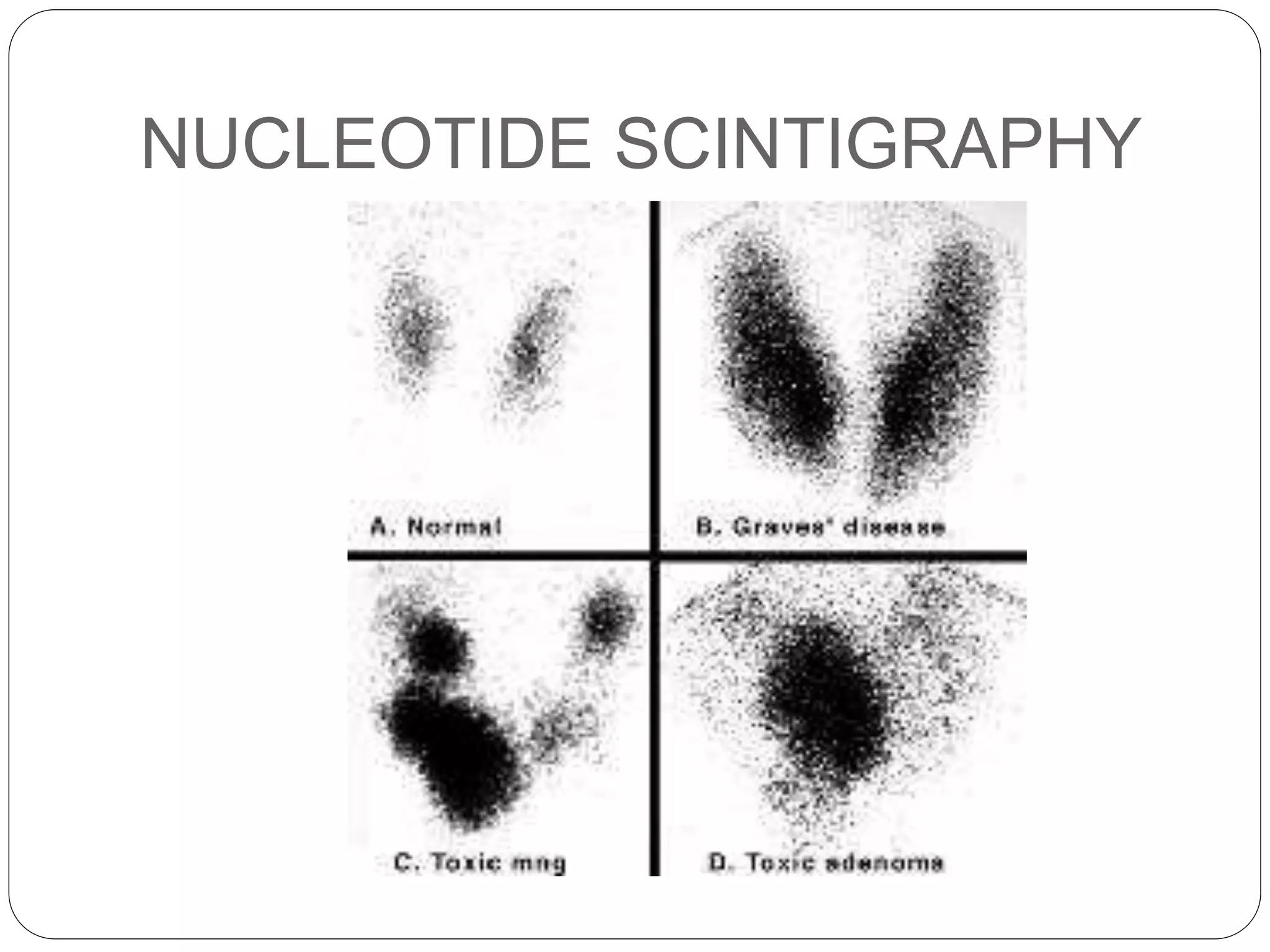 NUCLEOTIDE SCINTIGRAPHY
 