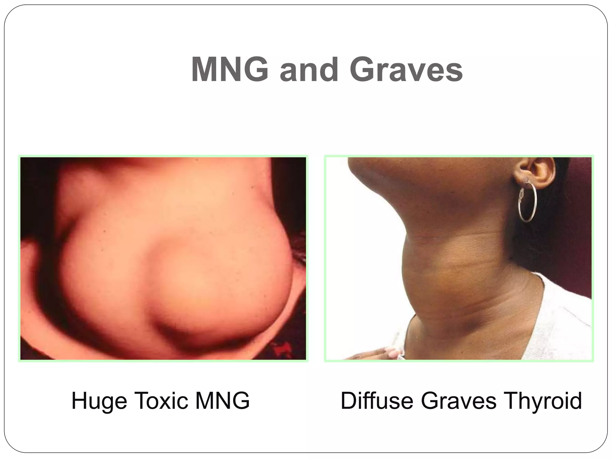 MNG and Graves
Huge Toxic MNG Diffuse Graves Thyroid
 
