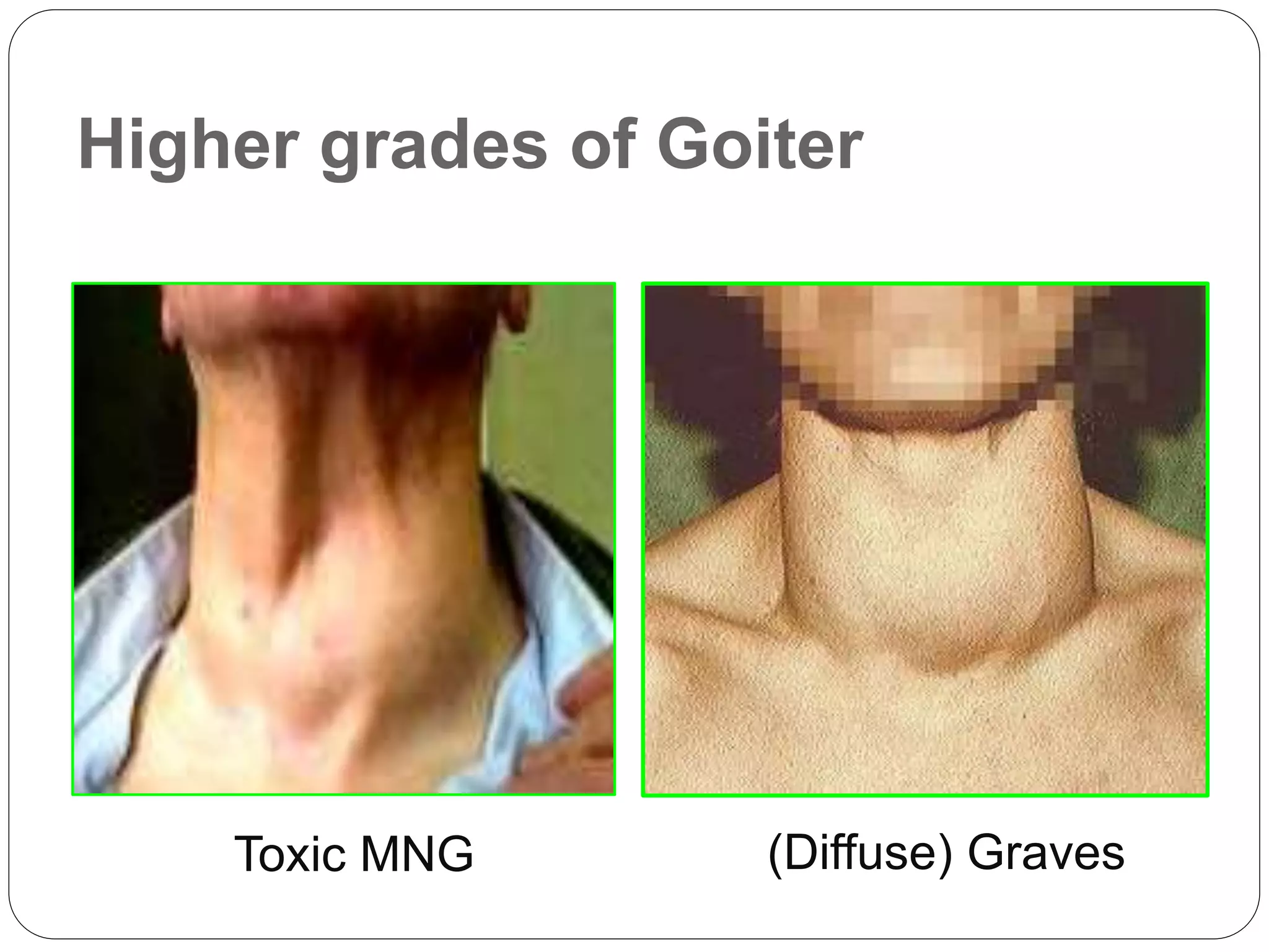 Higher grades of Goiter
Toxic MNG (Diffuse) Graves
 
