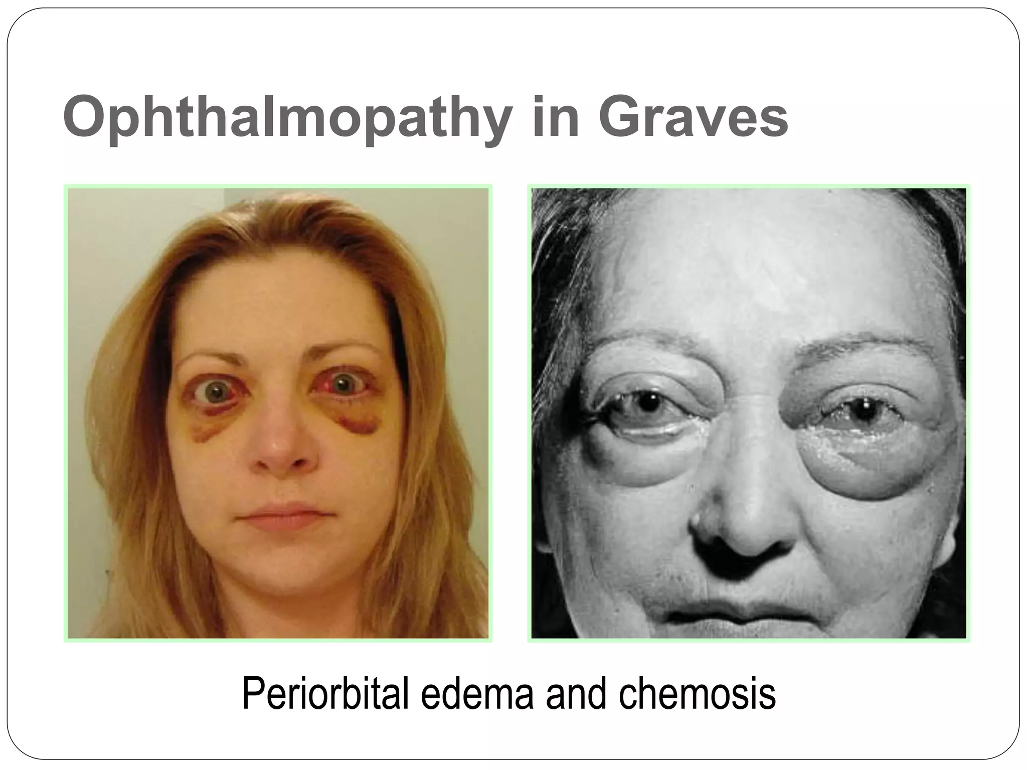 Ophthalmopathy in Graves
Periorbital edema and chemosis
 