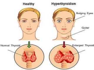 Hypernephroides Hyperthyroidism | PPTX