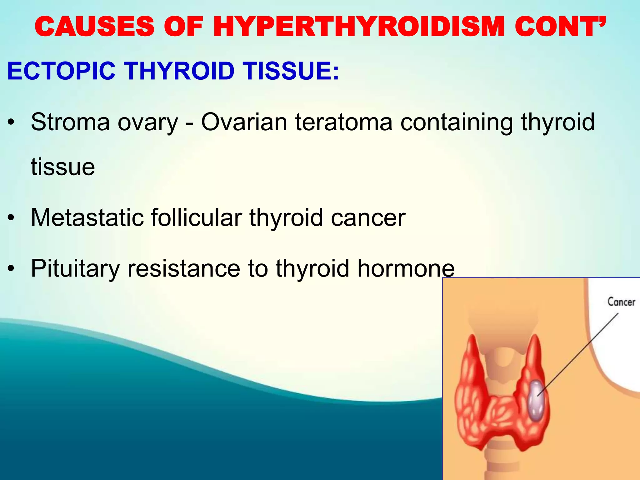 CAUSES OF HYPERTHYROIDISM CONT’
ECTOPIC THYROID TISSUE:
• Stroma ovary - Ovarian teratoma containing thyroid
tissue
• Metastatic follicular thyroid cancer
• Pituitary resistance to thyroid hormone
 