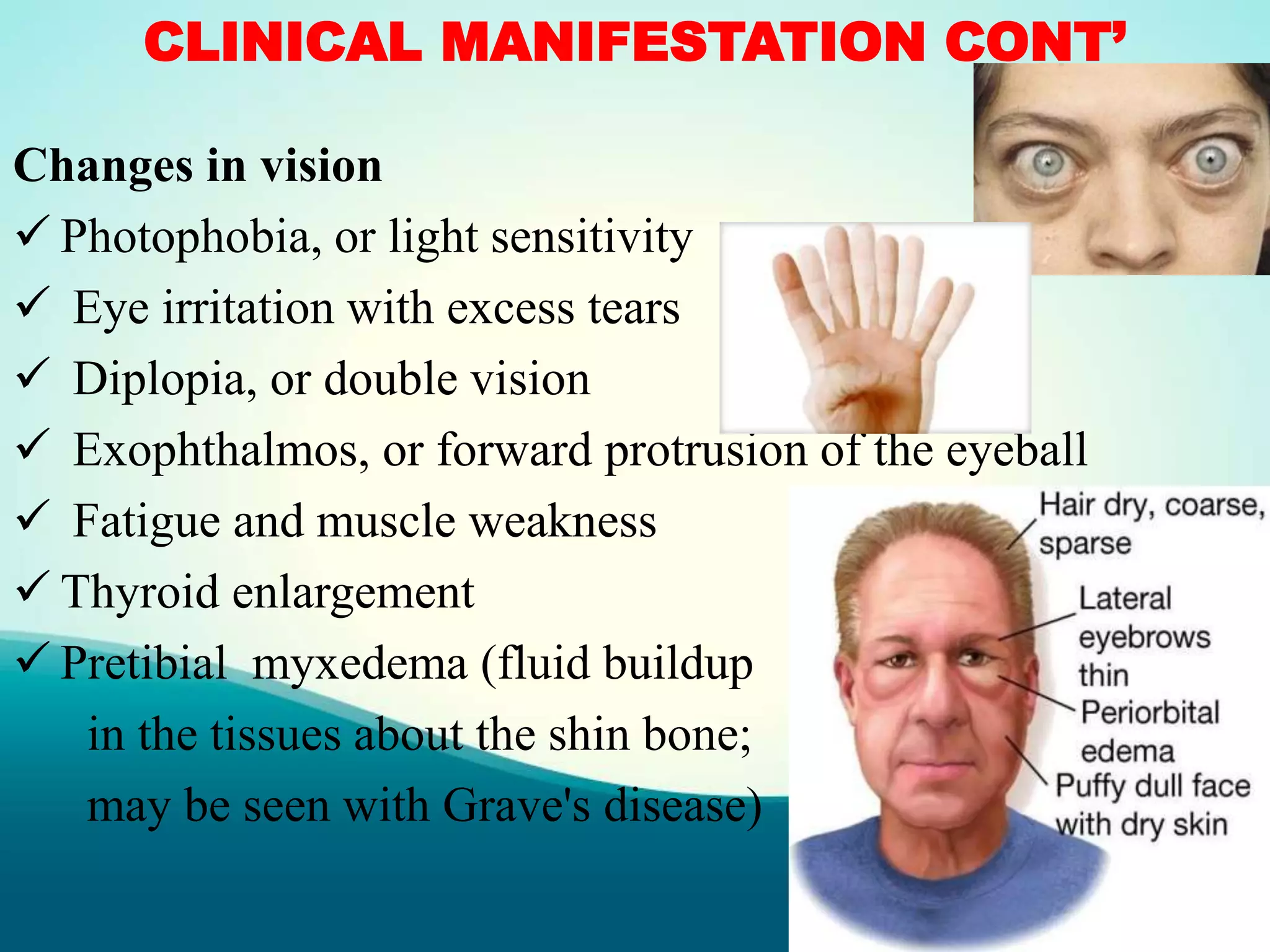 CLINICAL MANIFESTATION CONT’
Changes in vision
 Photophobia, or light sensitivity
 Eye irritation with excess tears
 Diplopia, or double vision
 Exophthalmos, or forward protrusion of the eyeball
 Fatigue and muscle weakness
 Thyroid enlargement
 Pretibial myxedema (fluid buildup
in the tissues about the shin bone;
may be seen with Grave's disease)
 