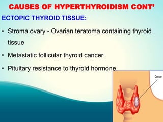 CAUSES OF HYPERTHYROIDISM CONT’
ECTOPIC THYROID TISSUE:
• Stroma ovary - Ovarian teratoma containing thyroid
tissue
• Metastatic follicular thyroid cancer
• Pituitary resistance to thyroid hormone
 