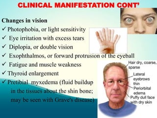 CLINICAL MANIFESTATION CONT’
Changes in vision
 Photophobia, or light sensitivity
 Eye irritation with excess tears
 Diplopia, or double vision
 Exophthalmos, or forward protrusion of the eyeball
 Fatigue and muscle weakness
 Thyroid enlargement
 Pretibial myxedema (fluid buildup
in the tissues about the shin bone;
may be seen with Grave's disease)
 