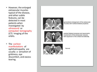 • However, the enlarged
extraocular muscles
typical of the disease,
and other subtle
features, can be
detected in most
patients when
investigated by
ultrasound or
computed tomography
(CT) imaging of the
orbits.
• The earliest
manifestations of
ophthalmopathy are
usually a sensation of
grittiness, eye
discomfort, and excess
tearing.
 