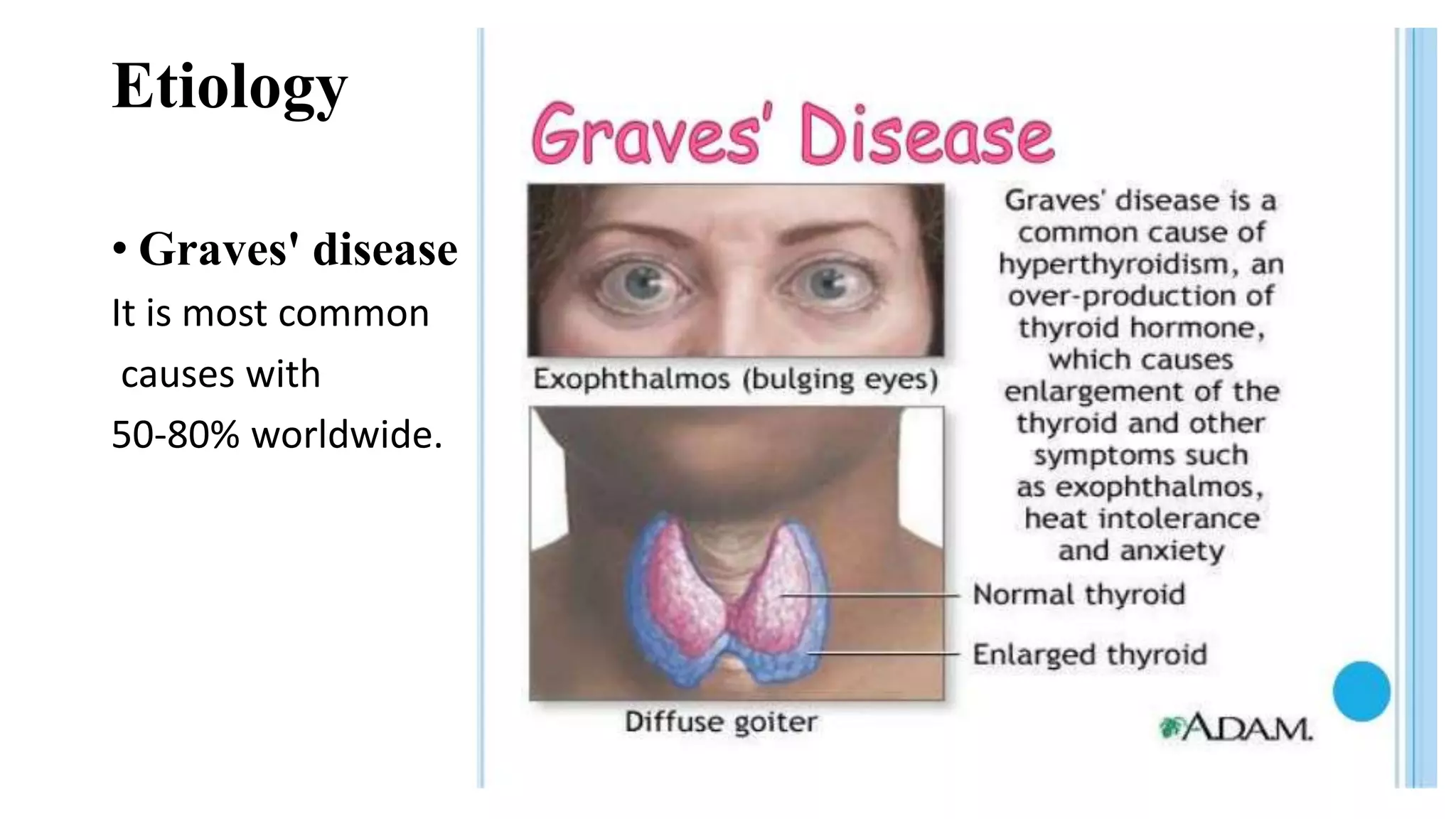 Etiology
• Graves' disease
It is most common
causes with
50-80% worldwide.
 