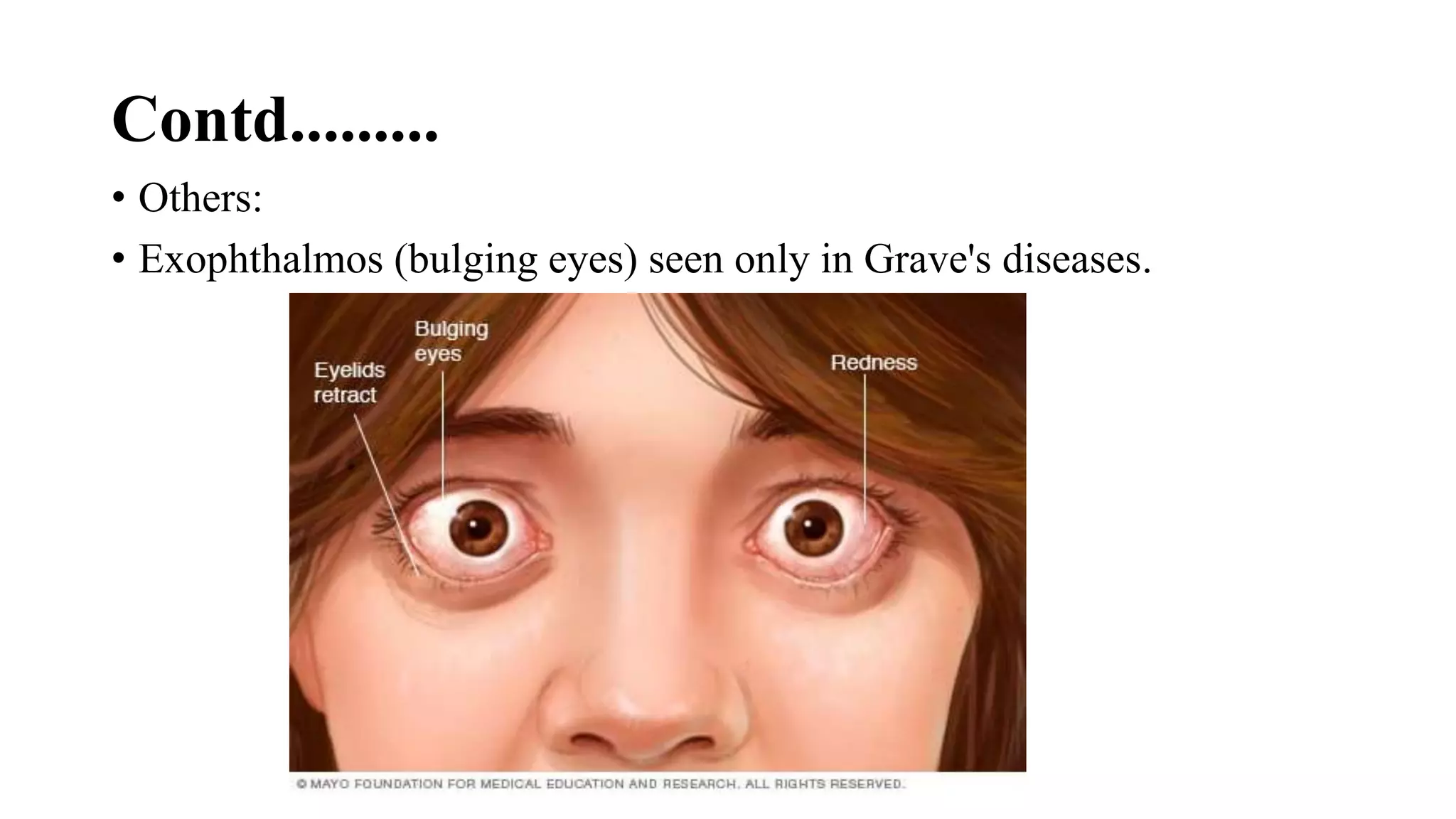 Contd.........
• Others:
• Exophthalmos (bulging eyes) seen only in Grave's diseases.
 
