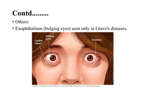 Contd.........
• Others:
• Exophthalmos (bulging eyes) seen only in Grave's diseases.
 