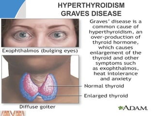 Comprehensive Overview of Thyroid Gland Disorders and Management | PPTX