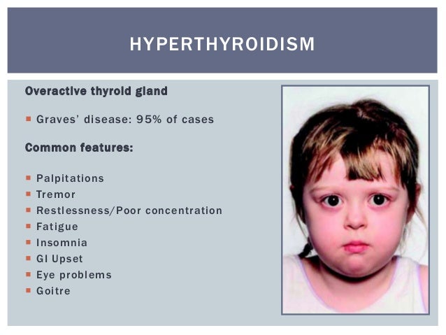 case study hyperthyroidism