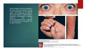 Graves disease. Note the proptosis of
the eyes, thyroid acropachy, and the
thyroid dermopathy on the pretibial
region. (From Goldsmith LA, Katze S,
Gilchrest B, Paller A, Leffel D, Wolff K.
Fitzpatrick’s Dermatology in General
Medicine, 8th ed.
www.accessmedicine.com. Copyright
© The McGraw-Hill Companies, Inc.
All rights reserved.)
Citation: 47 GRAVES DISEASE, Shamus E. The Color Atlas of Physical Therapy; 2015. Available at:
https://accessphysiotherapy.mhmedical.com/content.aspx?sectionid=90317395&bookid=1491&Resultclick=2
Accessed: February 26, 2023
Copyright © 2023 McGraw-Hill Education. All rights reserved
 