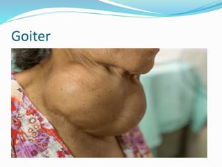 Goiter
 