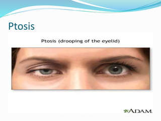 Ptosis
 