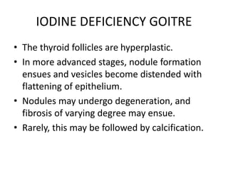 IODINE DEFICIENCY GOITRE
• The thyroid follicles are hyperplastic.
• In more advanced stages, nodule formation
ensues and vesicles become distended with
flattening of epithelium.
• Nodules may undergo degeneration, and
fibrosis of varying degree may ensue.
• Rarely, this may be followed by calcification.
 