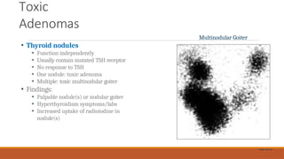 Toxic
Adenomas
• Thyroid nodules
• Function independently
• Usually contain mutated TSH receptor
• No response to TSH
• One nodule: toxic adenoma
• Multiple: toxic multinodular goiter
• Findings:
• Palpable nodule(s) or nodular goiter
• Hyperthyroidism symptoms/labs
• Increased uptake of radioiodine in
nodule(s)
Multinodular Goiter
Public Domain
 