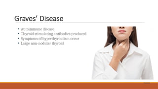 Graves’ Disease
• Autoimmune disease
• Thyroid stimulating antibodies produced
• Symptoms of hyperthyroidism occur
• Large non-nodular thyroid
Shutterstock
 