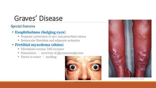 Graves’ Disease
Special features
• Exophthalmos (bulging eyes)
• Proptosis (protrusion of eye) and periorbital edema
• Retroocular fibroblast and adipocyte activation
• Pretibial myxedema (shins)
• Fibroblasts contain TSH receptor
• Stimulation  secretion of glycosaminoglycans
• Draws in water  swelling
Jonathan Trobe, M.D./Wikipedia
Herbert L. Fred, MD and Hendrik A. van Dijk
 