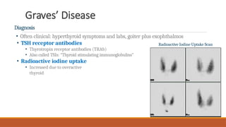 Graves’ Disease
Diagnosis
• Often clinical: hyperthyroid symptoms and labs, goiter plus exophthalmos
• TSH receptor antibodies
• Thyrotropin receptor antibodies (TRAb)
• Also called TSIs: “Thyroid stimulating immunoglobulins”
• Radioactive iodine uptake
• Increased due to overactive
thyroid
Radioactive Iodine Uptake Scan
 