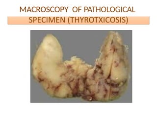 Comprehensive Approach to Hyperthyroidism: Diagnosis and Treatment | PPTX