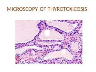 Comprehensive Approach to Hyperthyroidism: Diagnosis and Treatment | PPTX