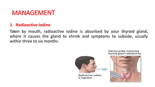 MANAGEMENT
1. Radioactive iodine
Taken by mouth, radioactive iodine is absorbed by your thyroid gland,
where it causes the gland to shrink and symptoms to subside, usually
within three to six months.
 