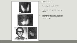 Figure 6-6. Thyroid Scans.
a. Normal thyroid imaged with 123I.
b. Cold nodule in the right lobe imaged by
99mTc.
c. Elderly woman with obvious multinodular
goiter and the corresponding radioiodide
scan on the right.
 