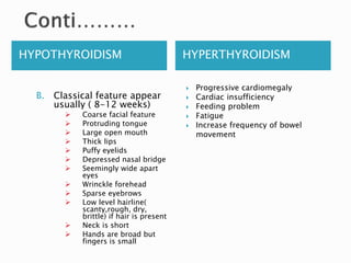 HYPOTHYROIDISM HYPERTHYROIDISM
B. Classical feature appear
usually ( 8-12 weeks)
 Coarse facial feature
 Protruding tongue
 Large open mouth
 Thick lips
 Puffy eyelids
 Depressed nasal bridge
 Seemingly wide apart
eyes
 Wrinckle forehead
 Sparse eyebrows
 Low level hairline(
scanty,rough, dry,
brittle) if hair is present
 Neck is short
 Hands are broad but
fingers is small
 Progressive cardiomegaly
 Cardiac insufficiency
 Feeding problem
 Fatigue
 Increase frequency of bowel
movement
 