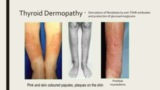 Hyperthyroid Skin Rash Hyperthyroidism in children | PPTX