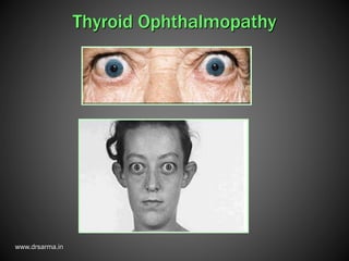 www.drsarma.in
Thyroid Ophthalmopathy
 