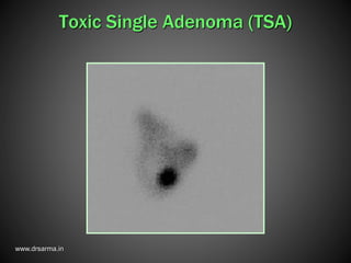www.drsarma.in
Toxic Single Adenoma (TSA)
 