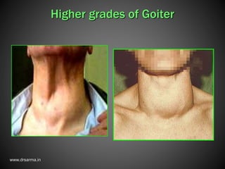 Hyperthyroidism management | PPTX