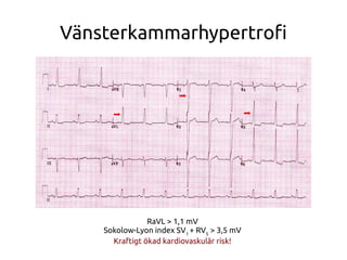 Vänsterkammarhypertrof
RaVL > 1,1 mV
Sokolow-Lyon index SV1
+ RV5
> 3,5 mV
Kraftigt ökad kardiovaskulär risk!
 