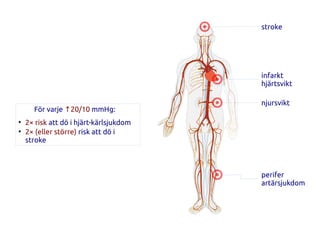 stroke
infarkt
hjärtsvikt
njursvikt
perifer
artärsjukdom
För varje ↑20/10 mmHg:
●
2× risk att dö i hjärt-kärlsjukdom
●
2× (eller större) risk att dö i
stroke
 