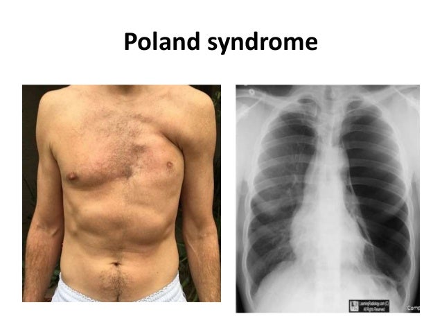 Hypertransradiant hemithorax