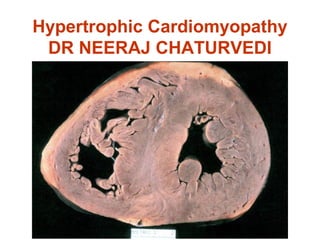Hypertrophic Cardiomyopathy
DR NEERAJ CHATURVEDI
 