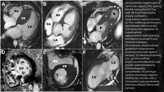 (A) Asymmetric hypertrophy of
ventricular septum (VS), sparing
the left ventricular (LV) free
wall. (B) Focal hypertrophy
sharply confined to
basal anterior septum (arrows).
(C)Thin-walled apical aneurysm
(arrowheads) with muscular
mid-ventricular apposition of
hypertrophied
septum and LV wall (asterisks),
and distinct proximal (P) and
distal (D) chambers.
(D) Extensive, transmural late
gadolinium enhancement
involving ventricular septum
(arrows). (E) Massive thickening
(i.e., 33 mm) confined
largely to anterolateral LV wall,
greatly underestimated by
echocardiography
(arrowheads). (F) Genotype
positive-phenotype negative
HCM family member with 3
myocardial crypts penetrating
thickness of basal inferior wall
(arrows).
 