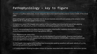 Pathophysiology – key to figure
Dynamic LV outflow obstruction. A to E, Subaortic obstruction due to systolic anterior motion (SAM) of the mitral
valve.
Echocardiographic apical four-chamber view at (A) end-diastole and at (B) end-systole as the anterior mitral
leaflet bends acutely with septal contact (arrow).
C, Continuous-wave (CW) Doppler interrogation of the LV outflow tract showing the typical late-peaking
waveform, with velocity of 4.2 m/s in midsystole, estimating a gradient of 70 mm Hg (arrow).
D and E, transesophageal echo plane showing incomplete mitral leaflet coaptation during SAM (arrow),
producing posteriorly directed mitral regurgitation (MR) jet.
F to I, Midventricular obstruction.
Echocardiographic apical four-chamber view at end-diastole (F) and end-systole, showing hypertrophied
anterolateral papillary muscle appearing to insert directly into anterior mitral leaflet, creating midventricular
muscular obstruction (G) (arrow).
H, CW Doppler interrogation of LV outflow tract showing late-peaking waveform with peak velocity of 3.3 m/s,
estimating a gradient of 45 mm Hg (arrow).
I, LV ventriculogram showing hourglass contour of chamber associated with midventricular obstruction (arrow)
 