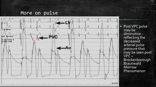 More on pulse
▪ PostVPC pulse
may be
diminutive -
reflecting the
decreased
arterial pulse
pressure that
may be seen post
VPC –
Brockenborough
Braunwald
Morrow
Phenomenon
 