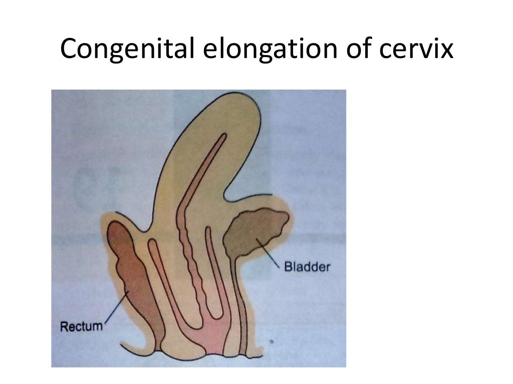 Hypertrophic elongated cervix (elongation of cervix)
