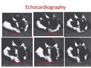 Echocardiography
A:Diastole B:Early systole C
D:Midsystole E:Mid-late systole F
 