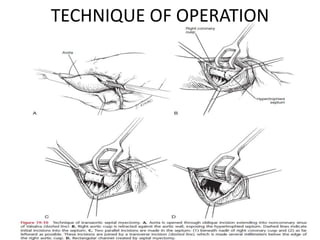 TECHNIQUE OF OPERATION
 