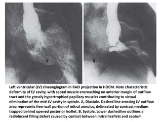 Left ventricular (LV) cineangiogram in RAO projection in HOCM. Note characteristic
deformity of LV cavity, with septal muscle encroaching on anterior margin of outflow
tract and the grossly hypertrophied papillary muscles contributing to virtual
elimination of the mid-LV cavity in systole. A, Diastole. Dashed line crossing LV outflow
area represents free-wall portion of mitral annulus, delineated by contrast medium
trapped behind opened posterior leaflet. B, Systole. Lower dashedline outlines a
radiolucent filling defect caused by contact between mitral leaflets and septum
A B
 