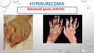 HYPERURECEMIA
Advanced gouty arthritis
 