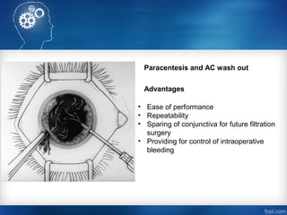 case of a blunt trauma to the left eye causing traumatic hyphema | PPT
