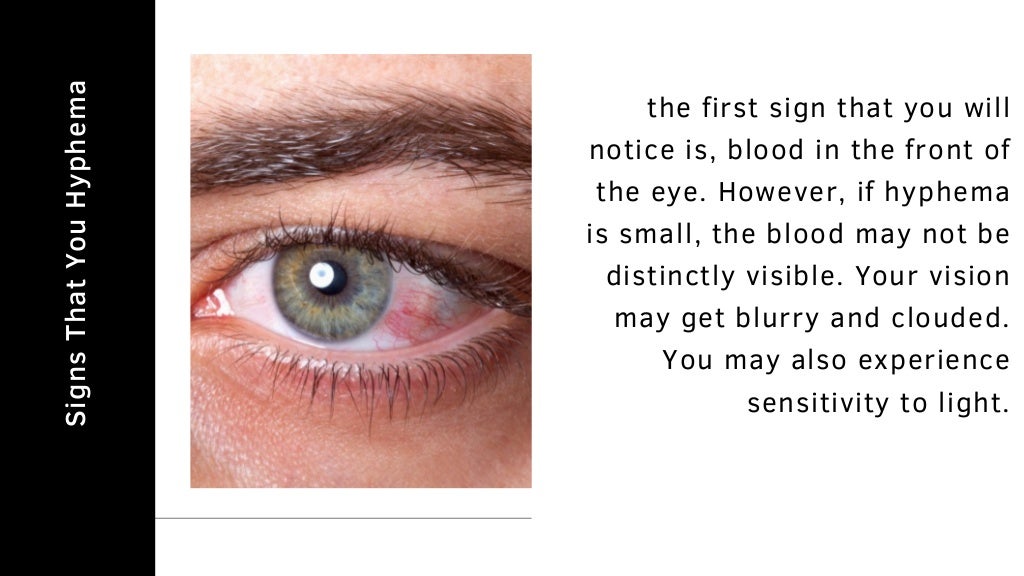 Hyphema 8 Facts About Internal Eye Bleeding