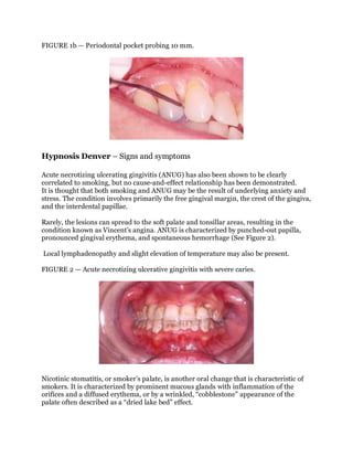 FIGURE 1b — Periodontal pocket probing 10 mm.
Hypnosis Denver – Signs and symptoms
Acute necrotizing ulcerating gingivitis...